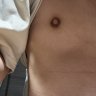 Nipple